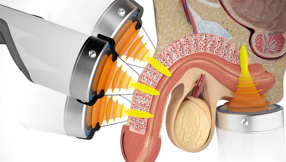Storz Wand Shock wave treatment forPenile revascularization therapy therapy and sexual dysfunction in Albuquerque, New Mexico 87120
